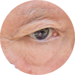 Those with excessive under-eye fat causing a bulging appearance