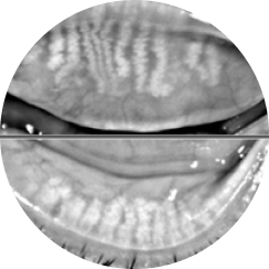 Meibomian Gland Examination