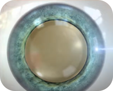 Corneal Incision