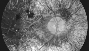 Non-Proliferative Diabetic Retinopathy (NPDR)