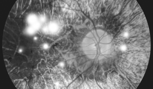 Proliferative Diabetic Retinopathy (PDR)