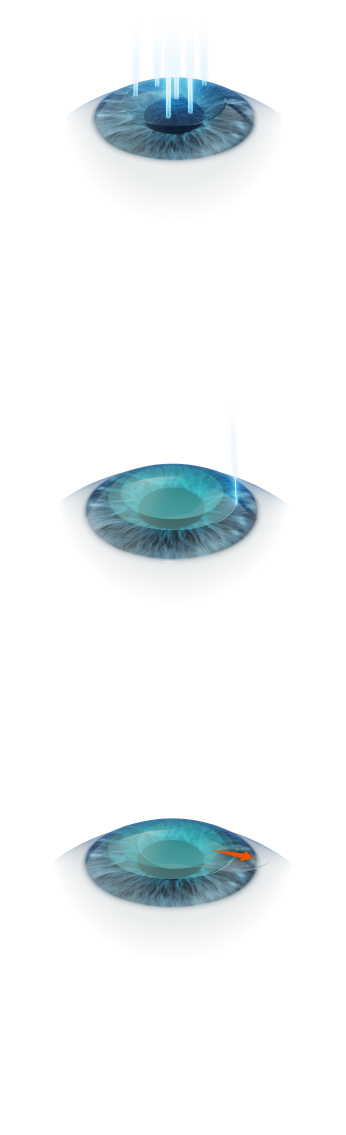 Instead of creating a corneal flap, it directly targets the corneal stroma. A minimal 2mm incision is made on the corneal surface. The corneal stroma is smoothly removed through the incision.